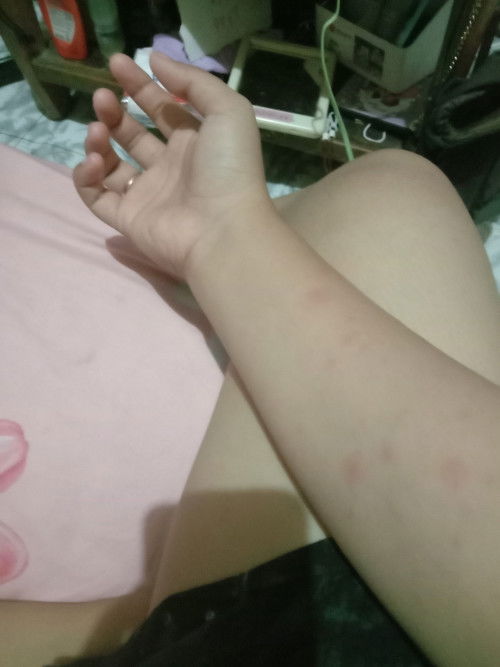 Disini ada gak Bun yang lagi hamil seluruh badan bintik2 merah seperti digigit nyamuk???