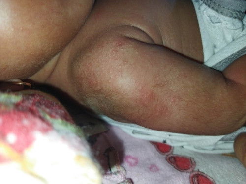 Merah merah di badan bayi