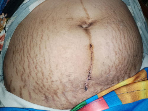 FTM cesarean dated Sept 21 2023