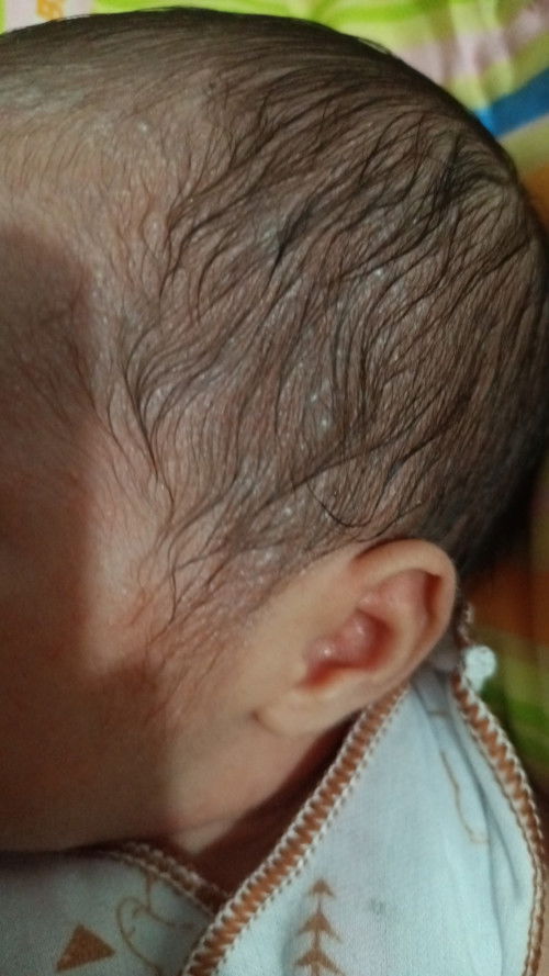 Kepala bayi bruntusan isi air