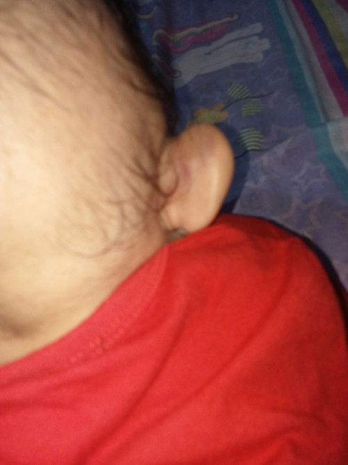 Telinga bengkak dan memar biru