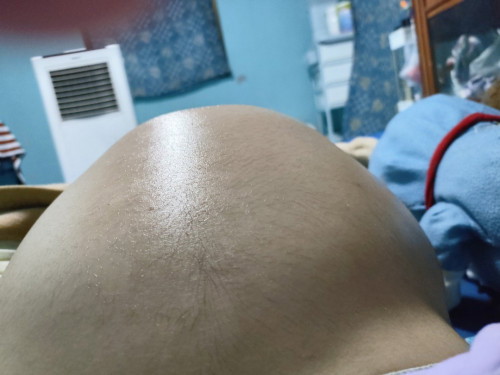 ท้องเบี้ยวฝังขวา