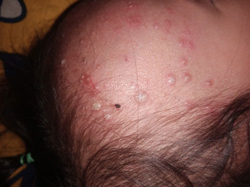 Bisul atau biang keringat