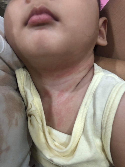 ผื่นแดงเกิดจากอะไรคะ?