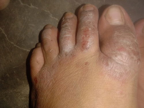 Jari Kaki gatel" nyeri perih sama kayak kluar semacam getah trus itu masalah gak yah di UK 35 week