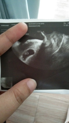 Sya 8week.tpi p klinik swta diorg ckp mybe sya yolk cas misscarge (tiada tnda2 gugur smpai skrg pon)