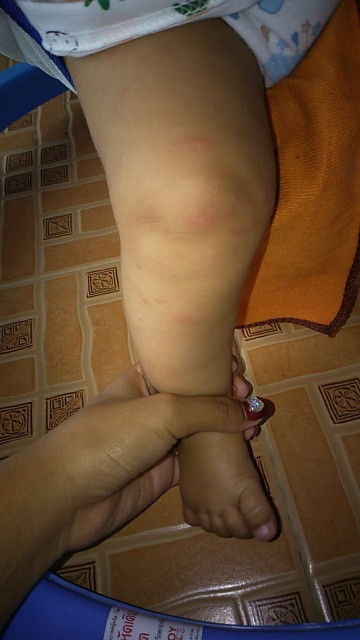 น้องโดนยุงกัด