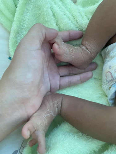 ทำยังไงให้มือกับเท้าน้องหายลอกหรอคะ