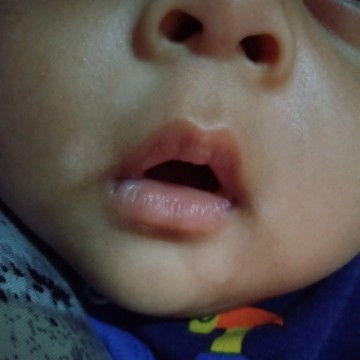 Bercak putih di area mulut