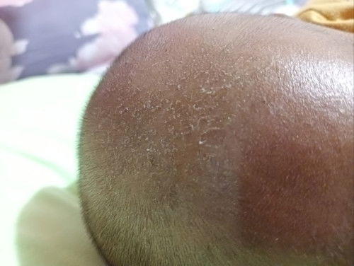 Cara mengatasi Kepala Bayi yg terkupas Seperti ketombe dan Gatal.