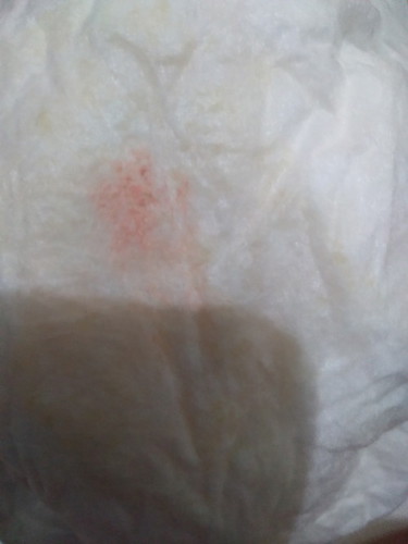 Bayi 5 bulan pipis bercampur darah