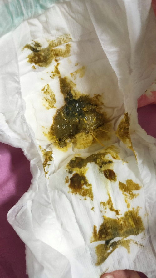 เปลี่ยนนมให้แล้ววันนี้น้องอึแบบนี้ปกติมั้ยคะ