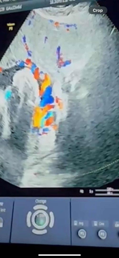 34 Weeks มีสายสะดือพันคอ กังวลค่ะ ขอคำปรึกษา