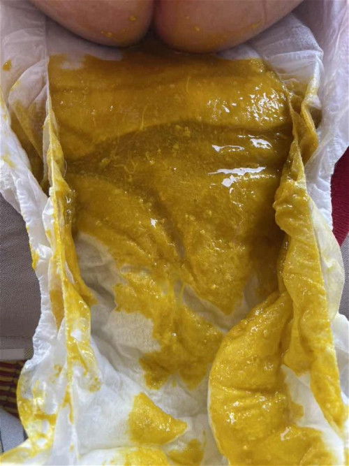 สอบถามอึแบบนี้ปกติไหม