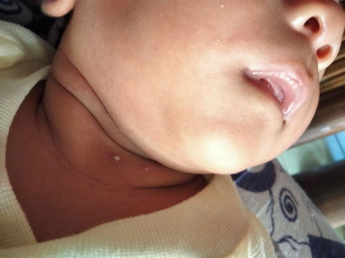 Muncul bintik nanah dileher