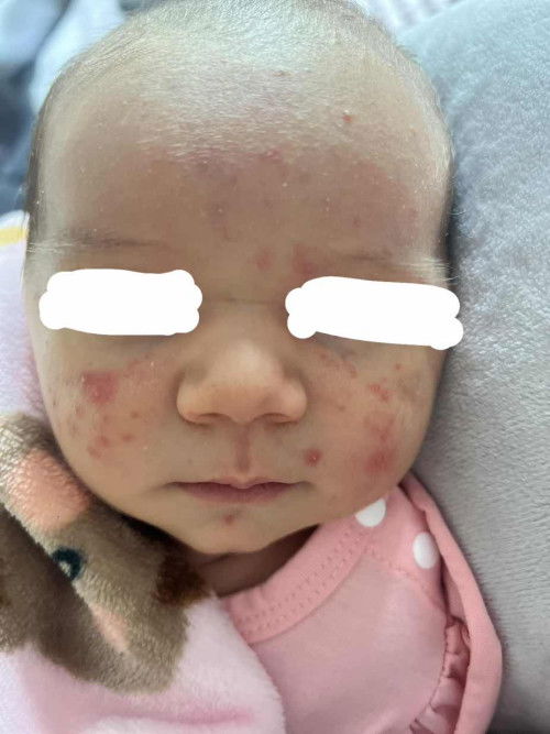 ขอความช่วยเหลือ คำแนะนำ ประสบการณ์จากแม่ๆ เรื่อง ผื่น แบบนี้หน่อยค่ะ🙏