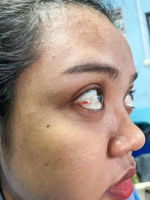 ตาแดง เป็นผลจากการท้องด้วยไหม