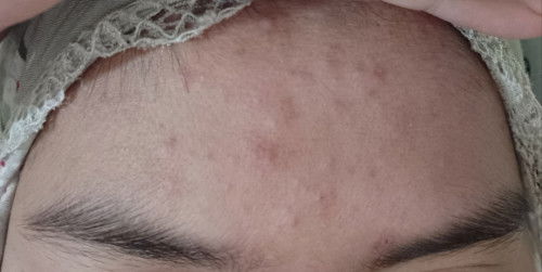 Jerawatan Saat Hamil itu bener gaksi Bun, adakah yang sama pernah ngalamin?