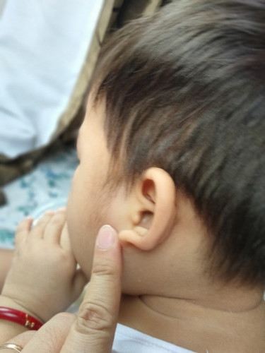 may bukol s face ni baby
