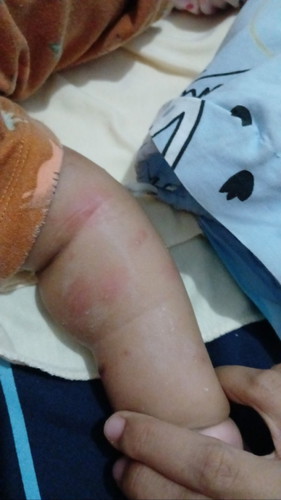 Bayi 6 bulan muncul merah² apa alergi makanan apa alergi cuaca ya ibuk² soalnya baru 2 minggu pindah