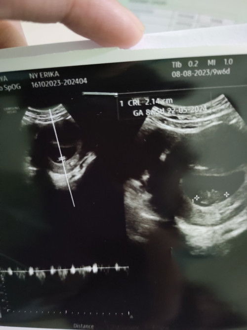 Beda usia hpht selisih 10hari