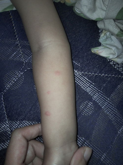 Tangan anak melenting merah