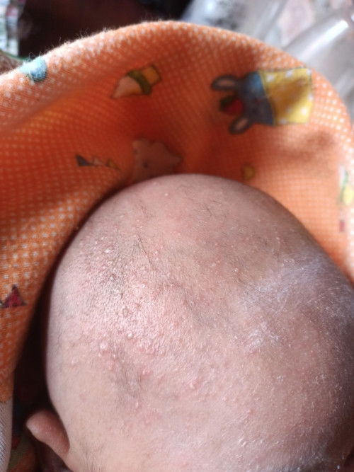 Bruntusan merah kadang berair