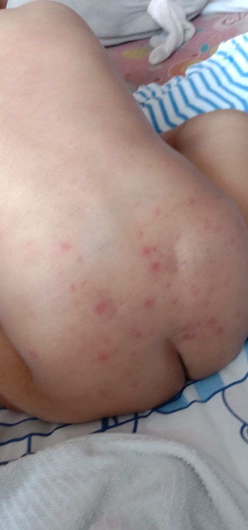 Eczema or ruam cacar?