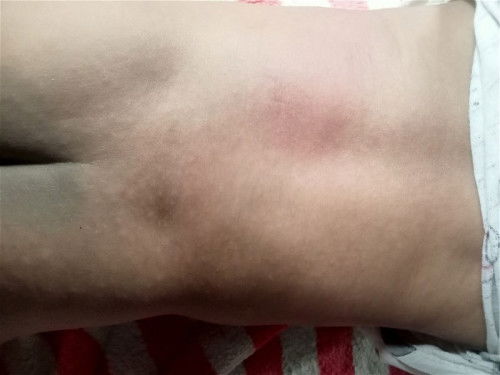 เป็นผื่นแบบนี้ผื่นอะไรคะ??