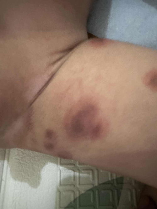 Gatal pada kulit bayi