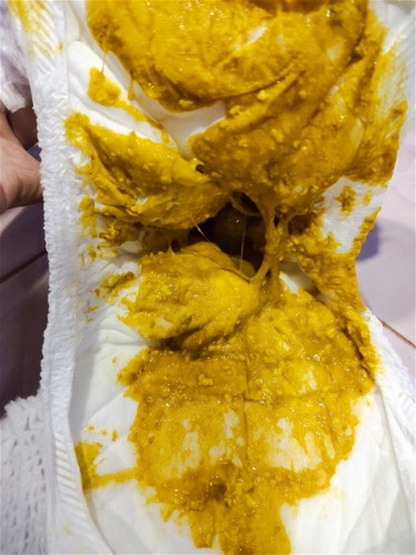 ลูก3เดือนถ่ายปนมูกใสๆ