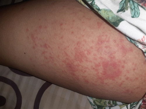 Gatal" masuk 37 week