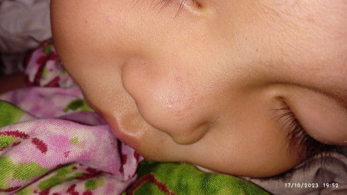 Bintik merah di hidung