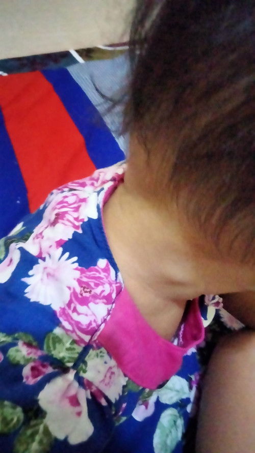 Benjolan dileher sudah 2 minggu tanpa gejala