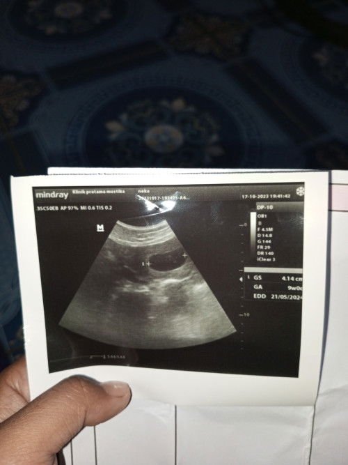 Lagi lagi janin tidak berkembang