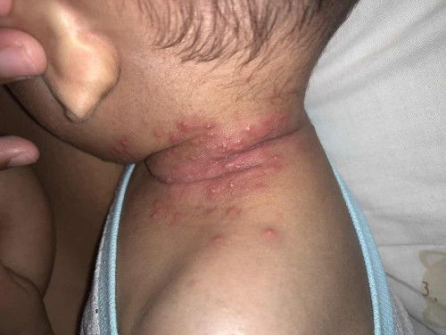 Bintik merah pada bayi sampai keluar nana