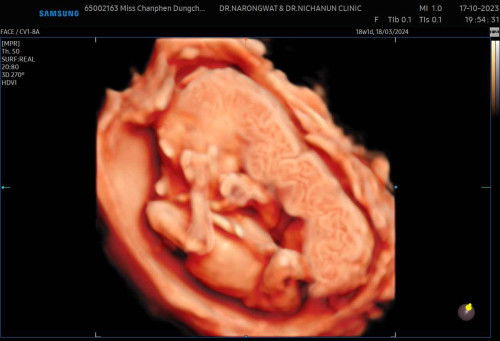 แบบนี้คือสายสะดือพันคอน้องมั้ยคะ แอบเครียดค่ะ