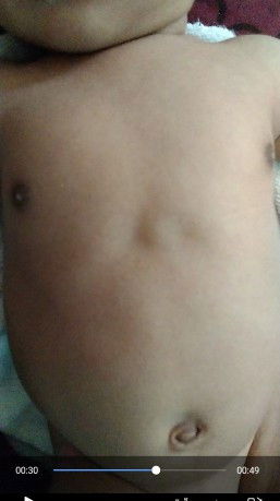 สอบถามค่ะกลางหน้าอกเวลาดิ้นมีอะไรไม่รู้ปูดขึ้นมาค่ะ