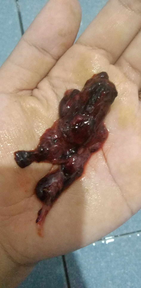 Are these signs of Miscarriage?