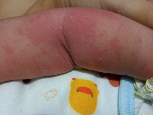 Kulit newborn