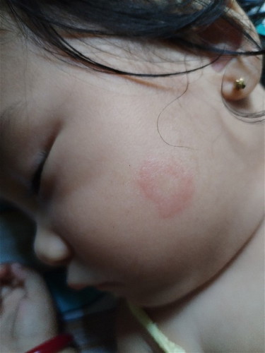 Allergy po ba ito?