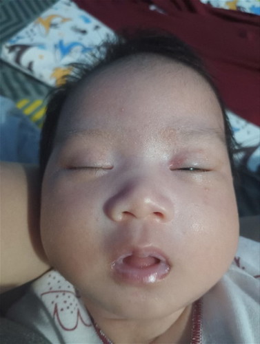 Ruam pada wajah bayi