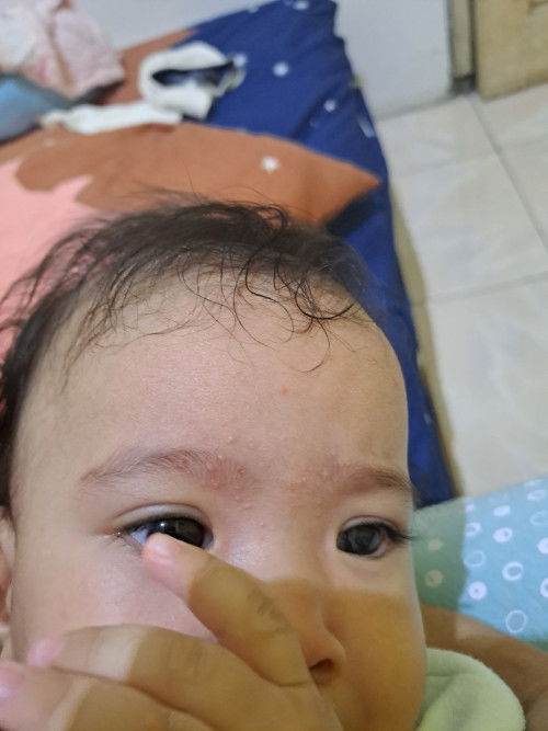 Bintik merah di alis bayi