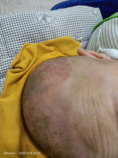 Awal nya kerak kepala tapi lama² JD merah berair Udah ke DSA 2x tp tetep seperti ini