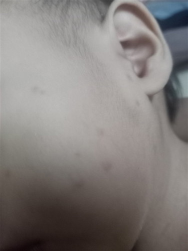 Ask kolang po ano po ba ito or ano po ba mabisang ipamahid po dito hinahayaan kolang sya pero