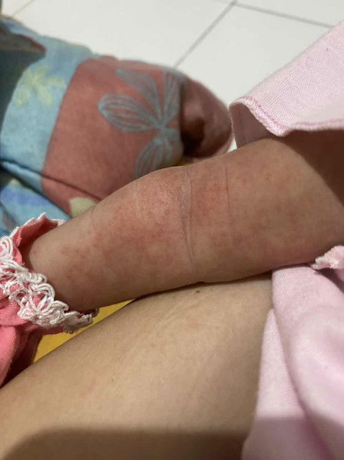 bintik bintik pada kulit baby