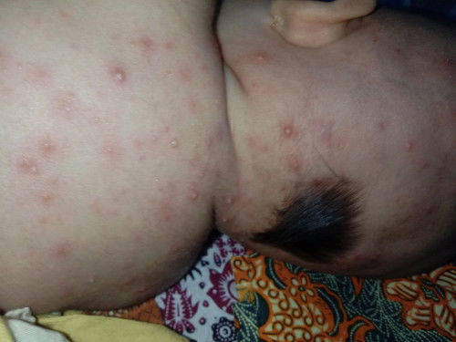 Bentol merah ada yang bernanah juga bayi 3 bulan