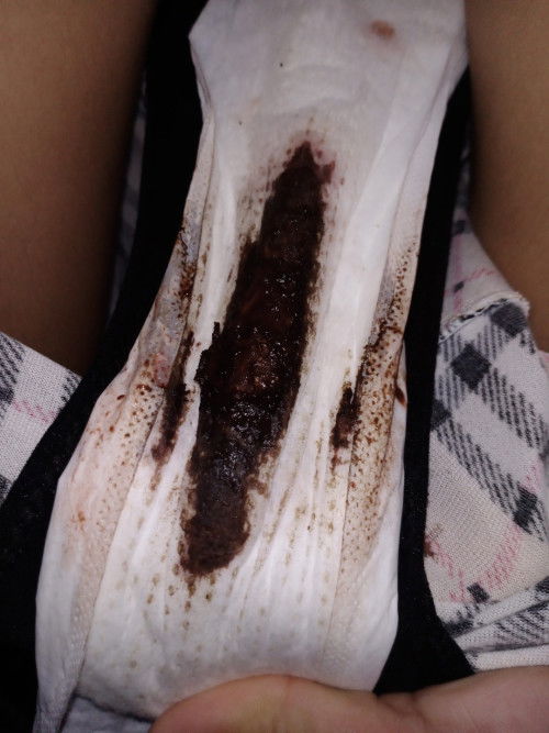 Pasintabi po.. normal pa po ba yan yung ganyan kadami lumalabas saking discharge? 5days na po ngayon