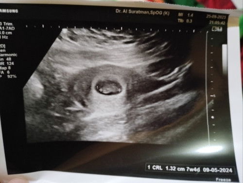 Keguguran 2x dlm setahun apa bisa hamil lagi secara sehat?