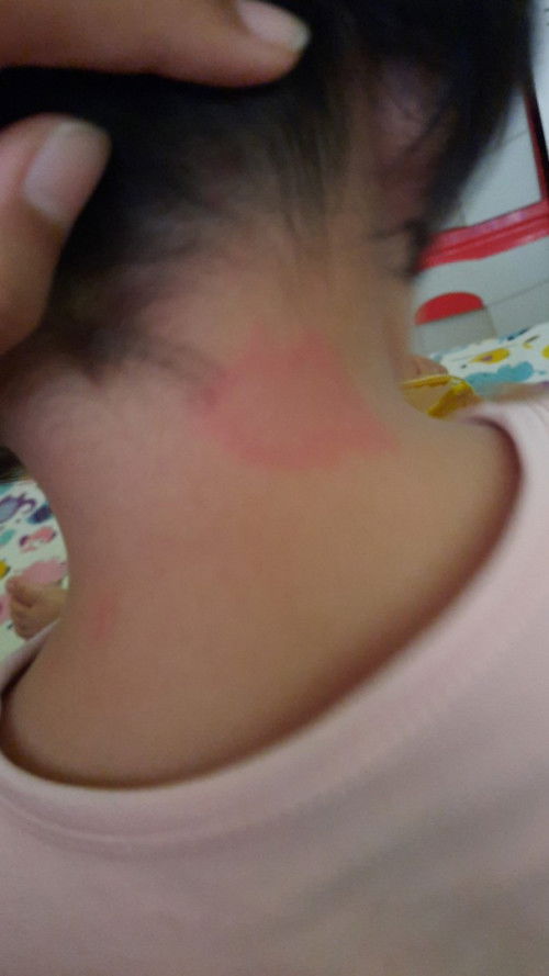 Merah² dibelakang leher